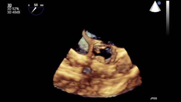 Transesophageal Ultrasound Video Mode — Stock Video
