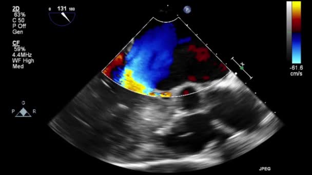 Transesophageal Ultrasound Video Doppler Mode — 비디오