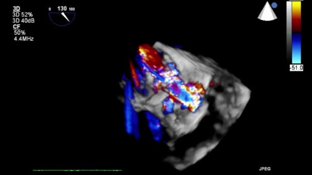 Transesophageal Ultrasound Video Mode — Stok video