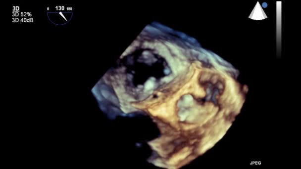 Transesophageal Ultrasound Video Mode — Stockvideo