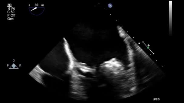 Transesophagales Ultraschallvideo Graustufen Modus — Stockvideo