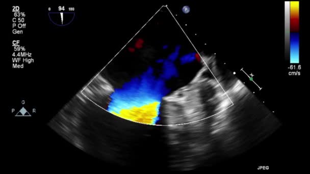 Transesophageal Ultrasound Video Doppler Mode — Stok video