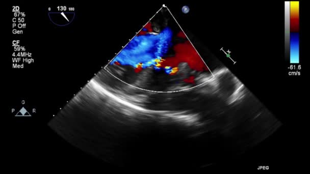 Transesophageal Ultrasound Video Doppler Mode — Stock Video