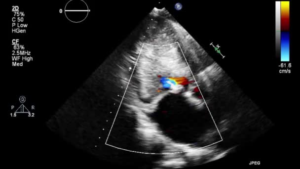 Transesophageales Ultraschallvideo Doppler Modus — Stockvideo