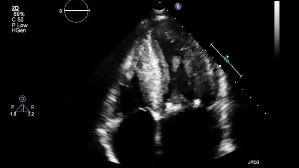 Transesophagales Ultraschallvideo Graustufen Modus — Stockvideo