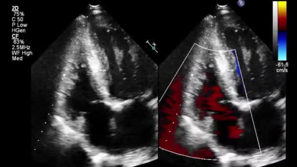 Transesofageale Echografie Video Doppler Modus — Stockvideo