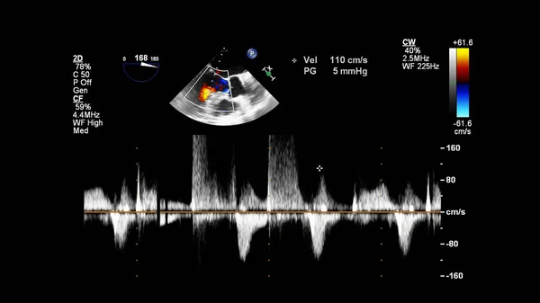 Imagem Coração Durante Ultrassom Transesofágico Com Modo Doppler — Fotografia de Stock