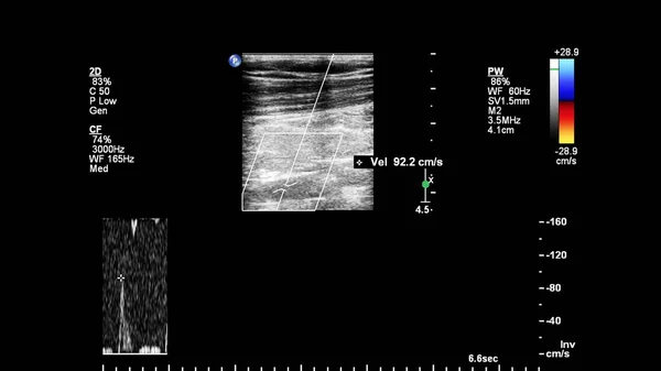 Badanie Usg Dopplerowskie Fal Impulsowych Naczyń — Zdjęcie stockowe