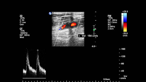 Доплеровское ультразвуковое исследование сосудов
.