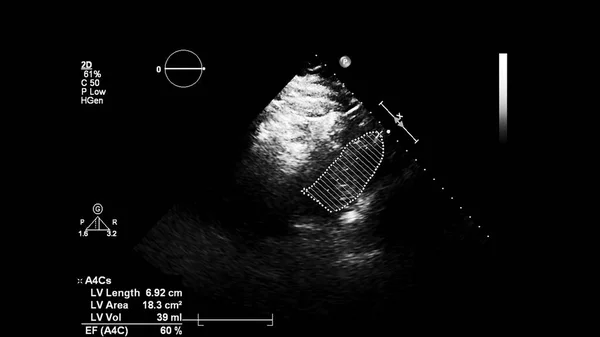 Image Cœur Mode Gris Lors Une Échographie Transœsophagienne — Photo