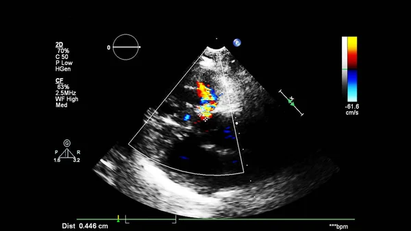 Изображение Сердца Время Трансофагеального Ультразвука Доплеровским Режимом — стоковое фото