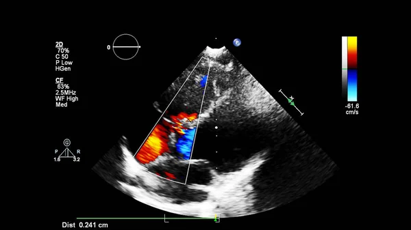 Immagine Del Cuore Durante Ecografia Transesofagea Con Modalità Doppler — Foto Stock