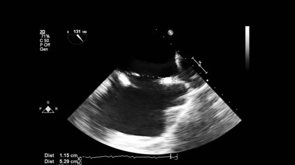 Transesofageal Ultrason Sırasında Kalbin Gri Ölçekli Görüntüsü — Stok fotoğraf