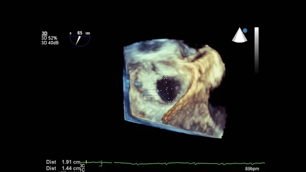 Obraz Srdce Během Transesophageální Ultrazvuk Srdce — Stock fotografie
