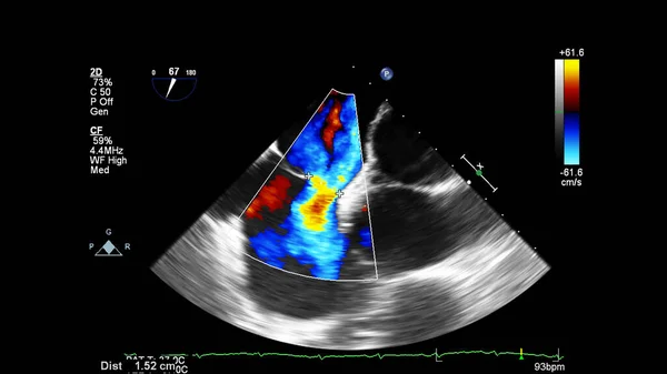 Bild Hjärtat Transesofagalt Ultraljud Med Dopplerläge — Stockfoto