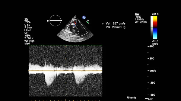 Imagem Coração Durante Ultrassom Transesofágico Com Modo Doppler — Fotografia de Stock