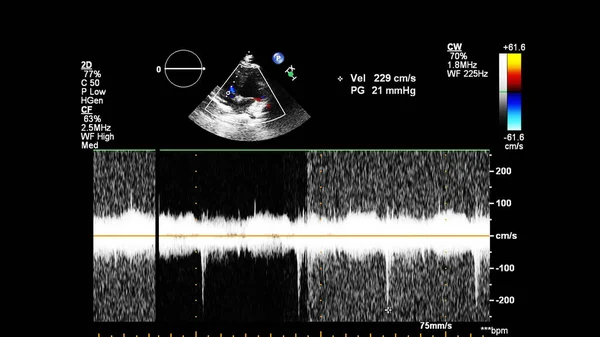 Transesofageal Ultrason Sırasında Doppler Kipi Ile Kalbin Görüntüsü — Stok fotoğraf