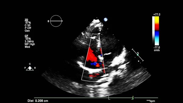 Imagen Del Corazón Durante Ecografía Transesofágica Con Modo Doppler —  Fotos de Stock