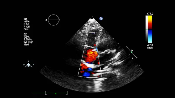 Immagine Del Cuore Durante Ecografia Transesofagea Con Modalità Doppler — Foto Stock