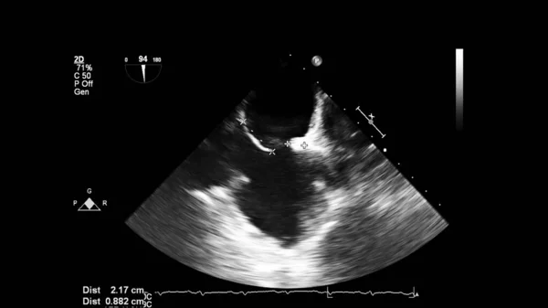 Изображение Сердца Сером Режиме Время Трансофагеального Ультразвука — стоковое фото
