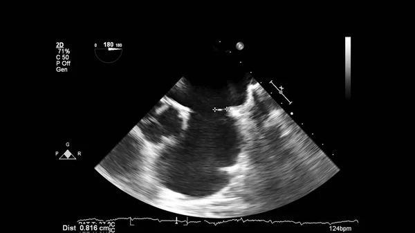 Kép Szív Szürke Skála Mód Során Transesophagealis Ultrahang — Stock Fotó