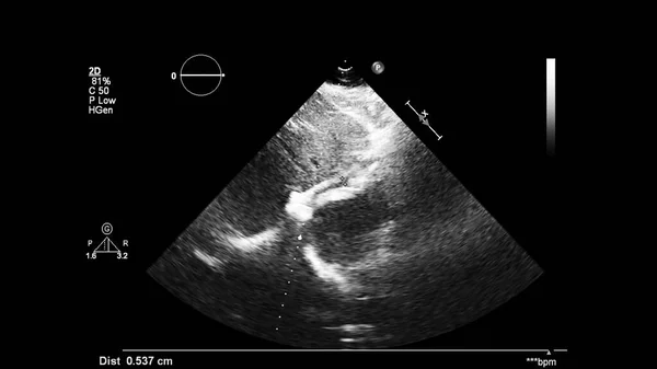 Afbeelding Van Het Hart Grijs Schaal Modus Tijdens Transesofageale Echografie — Stockfoto