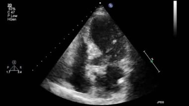 Kalbin ultrason transsofageal muayenesi.
