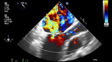 Kalbin ultrason transsofageal muayenesi.
