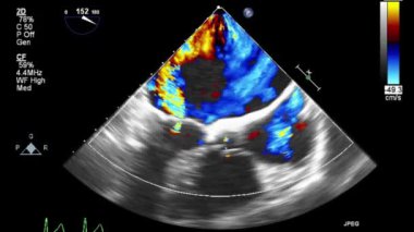 Kalbin ultrason transsofageal muayenesi.