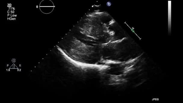 超声经食管检查心脏 — 图库视频影像