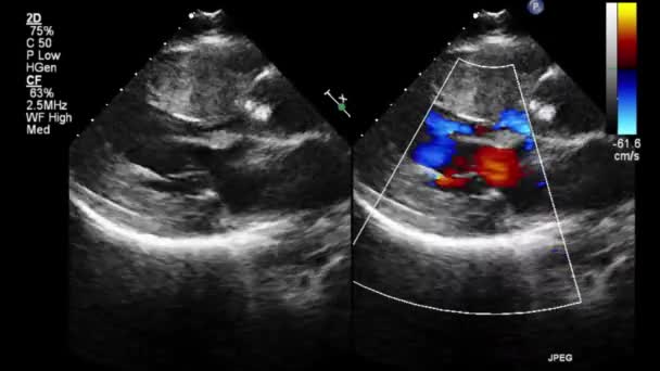 Echografie Transslokdarmonderzoek Van Het Hart — Stockvideo