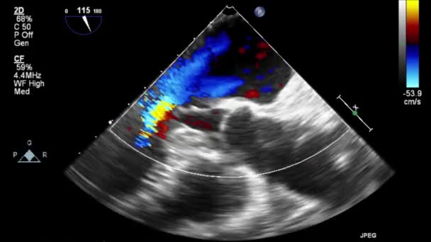 Kalbin Ultrason Transsofageal Muayenesi — Stok video