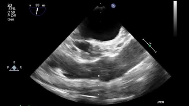 Echografie Transslokdarmonderzoek Van Het Hart — Stockvideo