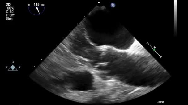 Echografie Transslokdarmonderzoek Van Het Hart — Stockvideo