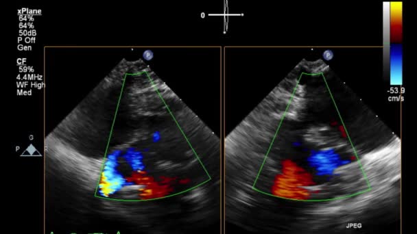 Exame Transesofágico Ultrassonográfico Coração — Vídeo de Stock