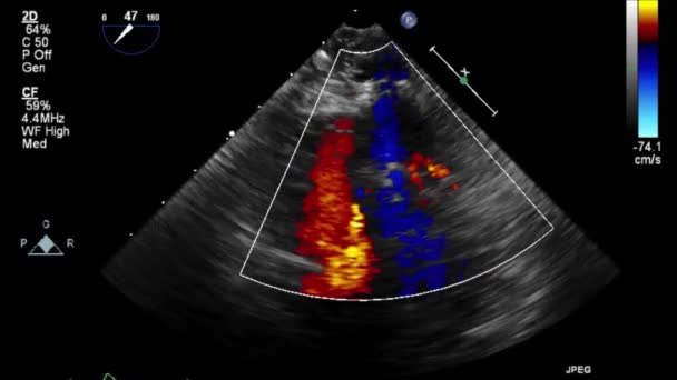 Ecografia Esame Transesofageo Del Cuore — Video Stock