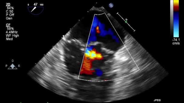 Echografie Transslokdarmonderzoek Van Het Hart — Stockvideo