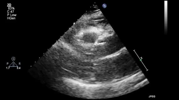 Exame Transesofágico Ultrassonográfico Coração — Vídeo de Stock