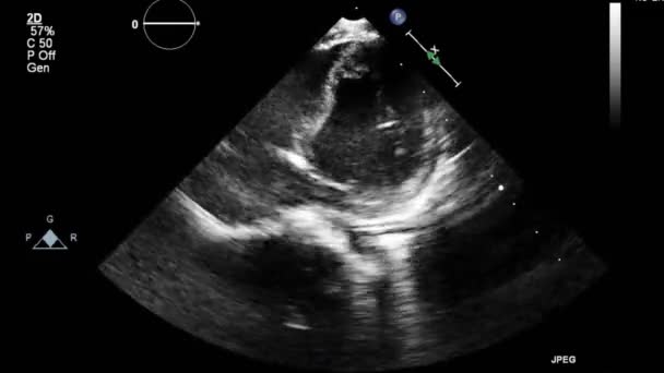 Ultraljudstransesofageal Undersökning Hjärtat — Stockvideo