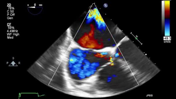 Ultrasound Transesophageal Examination Heart — Stock Video