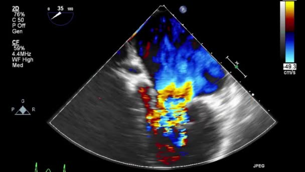 Ultrasound Transesophageal Examination Heart — Stock Video