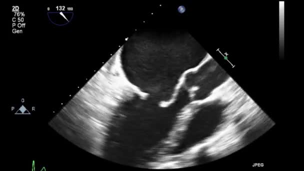 Echografie Transslokdarmonderzoek Van Het Hart — Stockvideo