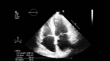 Image of the heart in gray-scale mode during transesophageal ultrasound. clipart