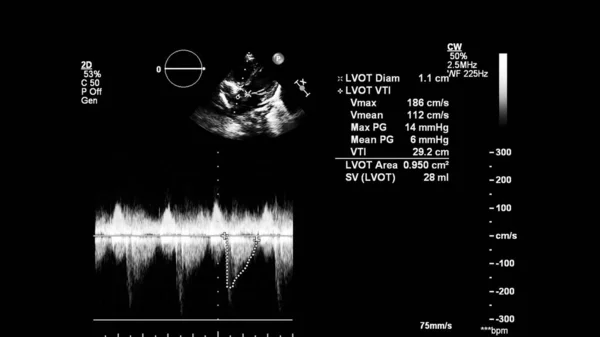 Image Heart Gray Scale Mode Transesophageal Ultrasound — Stock Photo, Image