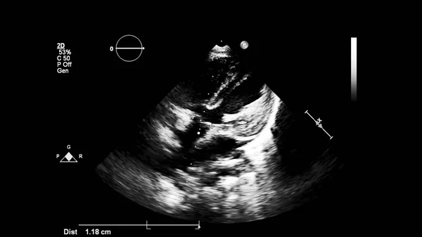 Imagem Coração Escala Cinza Durante Ultrassonografia Transesofágica — Fotografia de Stock