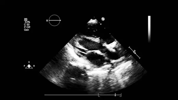 Изображение Сердца Сером Режиме Время Трансофагеального Ультразвука — стоковое фото