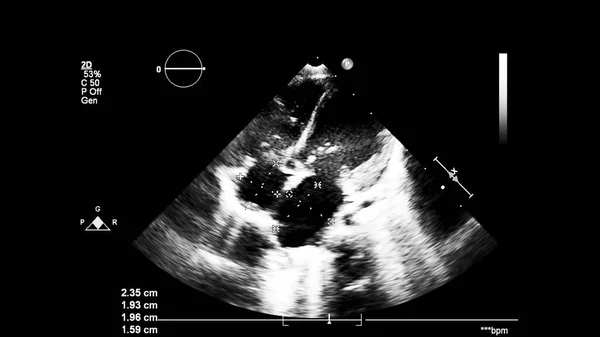 Transesofageal Ultrason Sırasında Kalbin Gri Ölçekli Görüntüsü — Stok fotoğraf