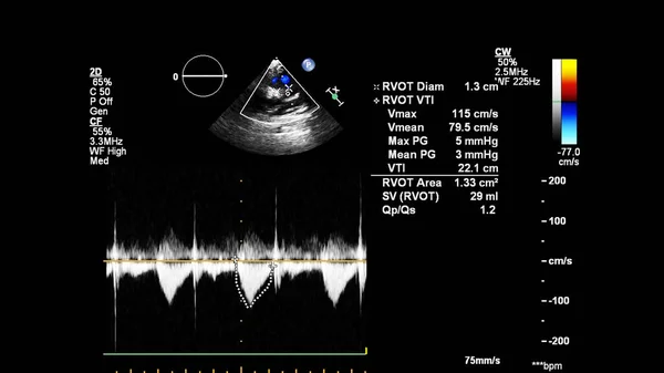 Imagem Coração Durante Ultrassom Transesofágico Com Modo Doppler — Fotografia de Stock