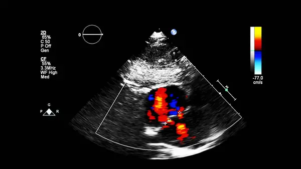 Immagine Del Cuore Durante Ecografia Transesofagea Con Modalità Doppler — Foto Stock