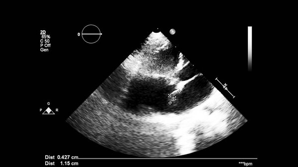 Изображение сердца в сером режиме во время трансофагеального ультразвука.
